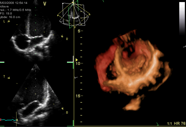 Right Ventricular Function 2 Echocardiographic Assessment Online